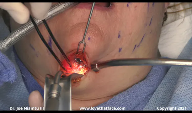 Case 1 Platysmaplasty and Comprehensive Facelift with SMASectomy