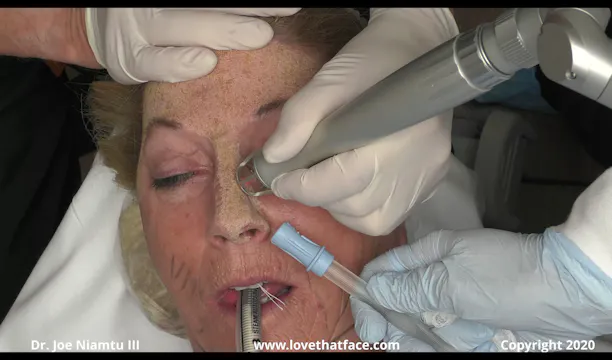 Case 2 Full Face CO2 Laser Resurfacing