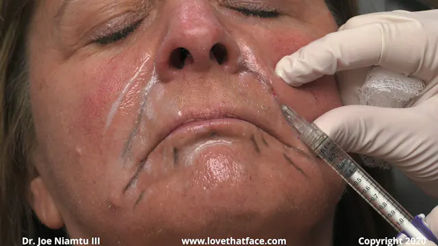 Juvederm Vollure to Nasolabial Folds and Perioral and Botox to 3 Areas