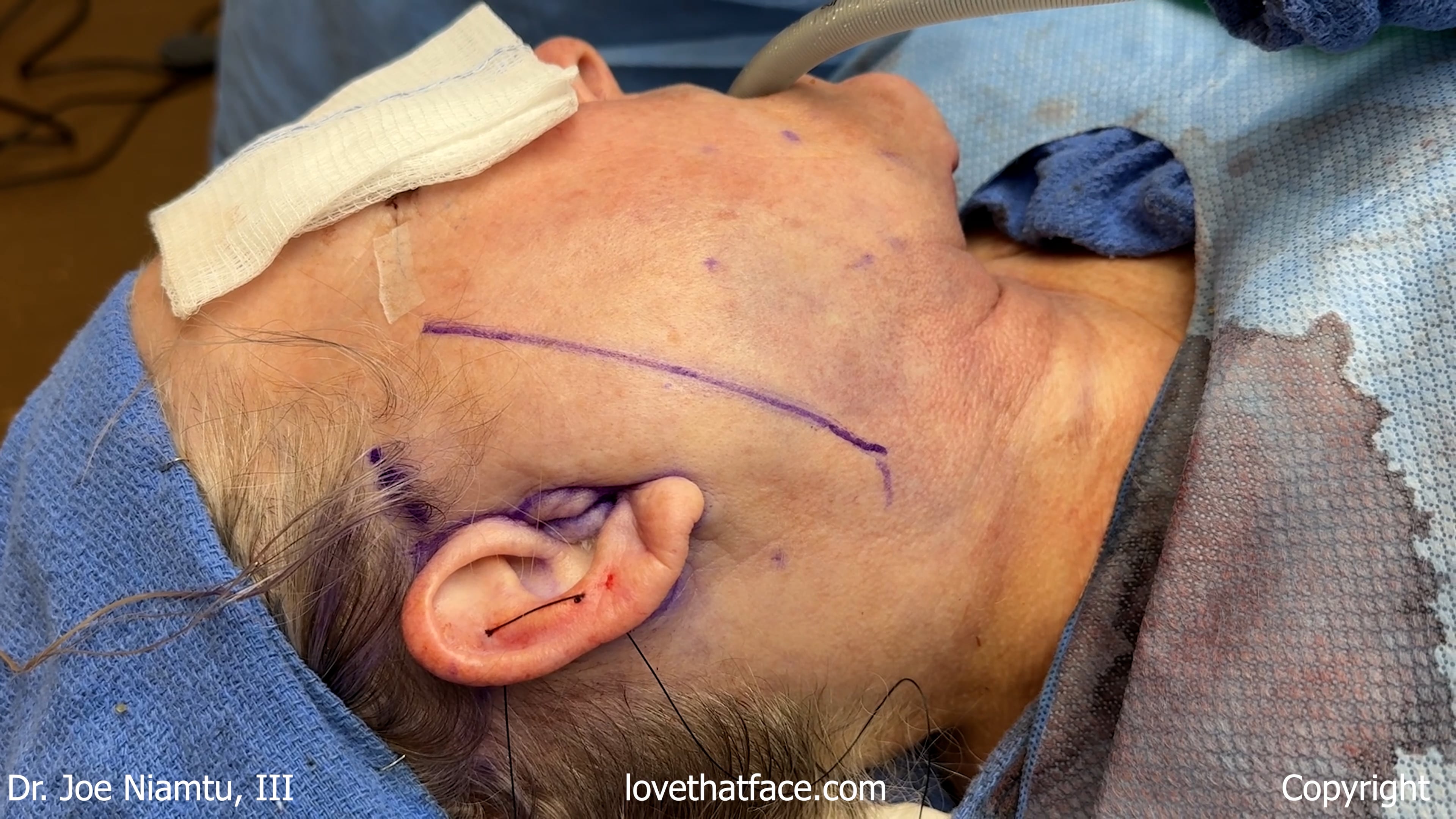 Skin and SMAS Dissection