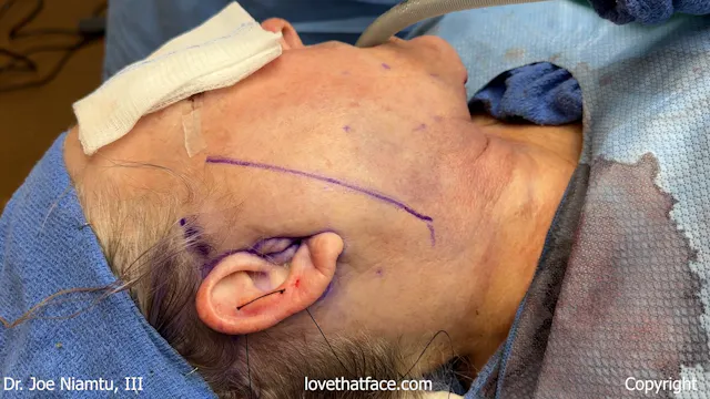 Skin and SMAS Dissection
