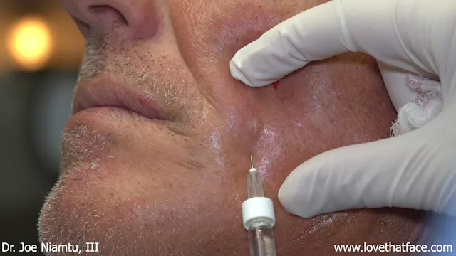 Restylane Injection to Facial Lines
