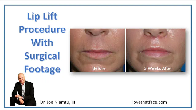 Lip Lift Procedure with Multiple Patients