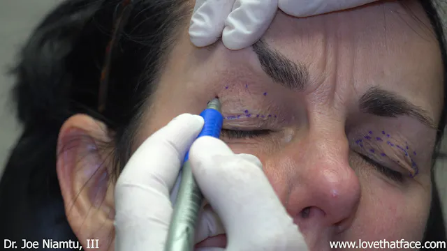 Blepharoplasty Marking Case 3