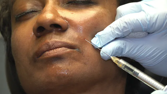 Juvederm Voluma to Nasolabial Folds with Cannula and Needle