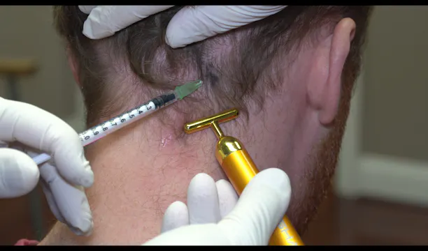 Botox Injection to Temporalis and posterior neck for TMD and Myofacial Pain