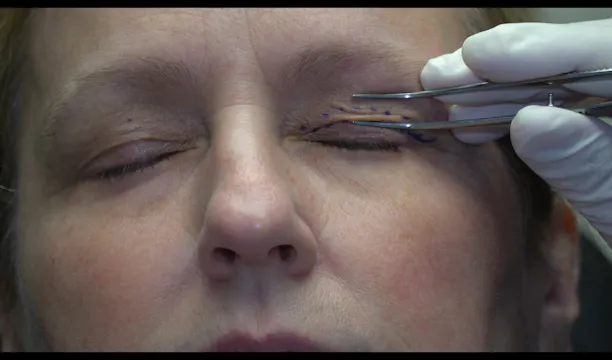 Fold Method of Upper Eyelid Blepharoplasty Marking