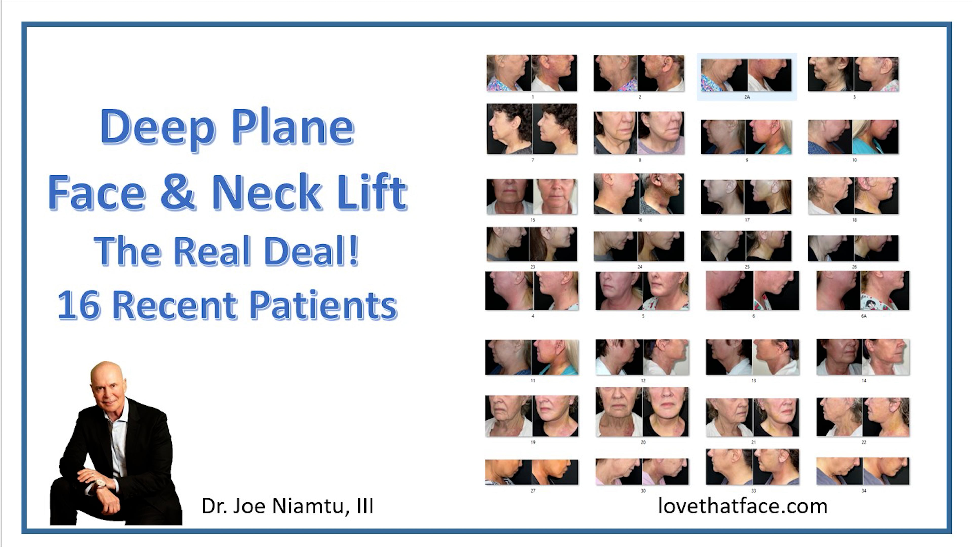16 Recent Deep Plane Facelift Patients