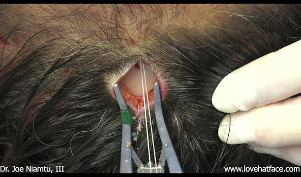 Endoscopic Brow and Forehead with Simultaneous Blepharoplasty Part 2
