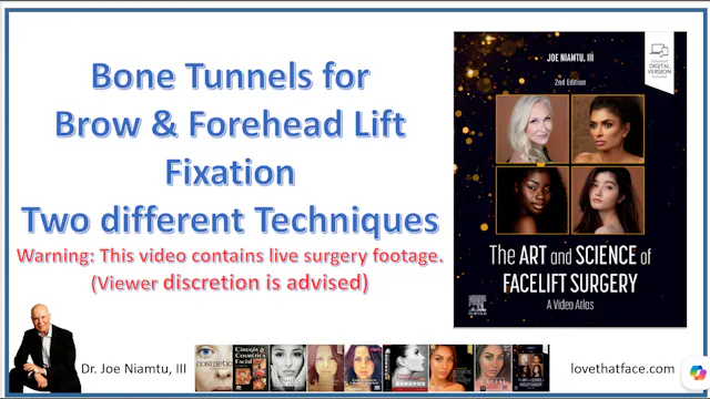 Bone Tunnels for Brow and Forehead Lift Fixation