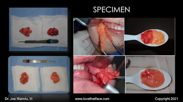 Platinum Management of Cervicofacial Fat Lecture