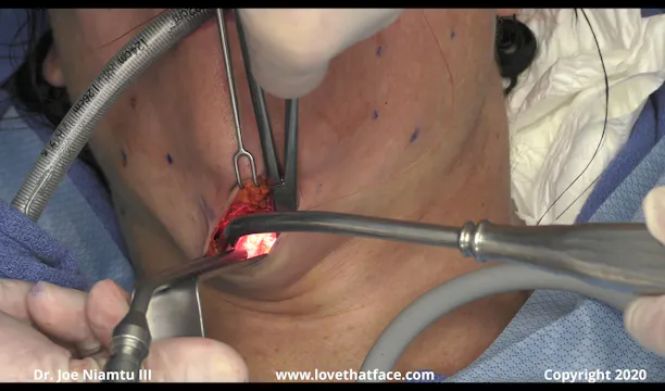 Single Side Facelift with Platysmaplasty Non Stop Part 1