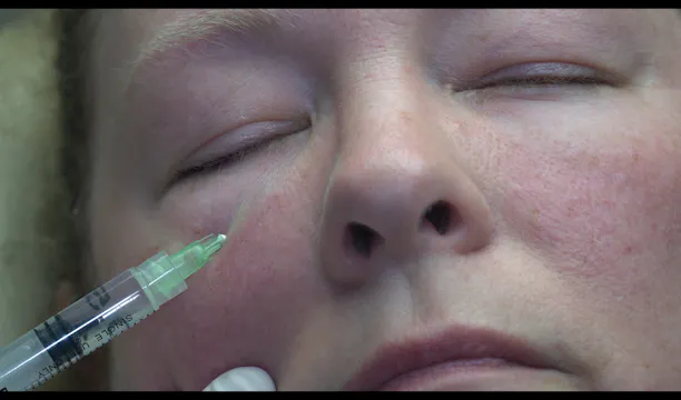 Dissolving 6 Year Old Voluma to Tear Troughs with Hyaluronidase