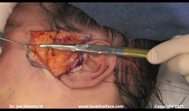 Posterior Tragal Facelift Incision and Reconstruction