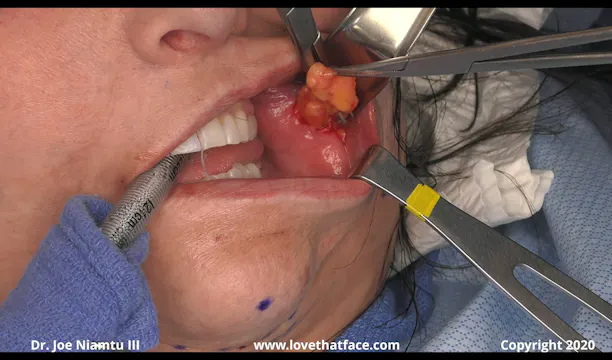 Buccal Fat Reduction Case 2