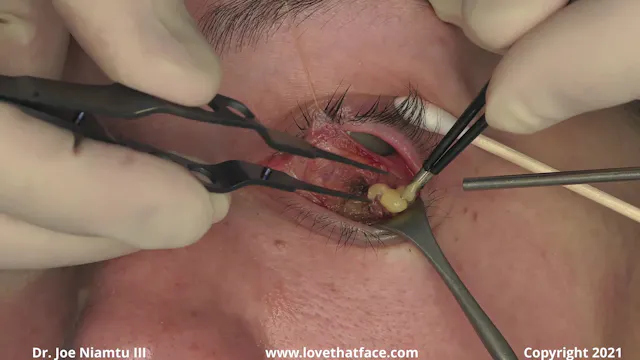 Soniquence Radiowave Assisted Lower Transconjunctival Blepharoplasty