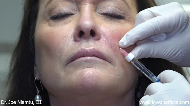 Restylane to Nasolabial Folds with Needle