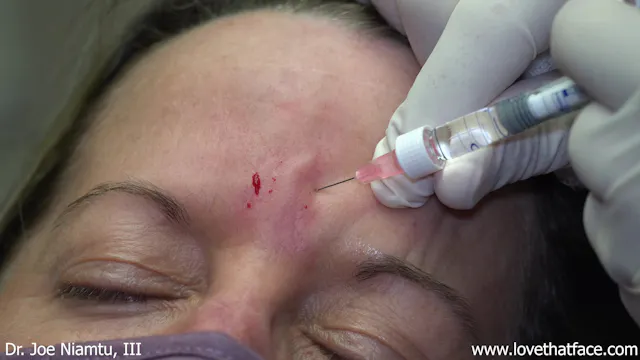 Restylane Injection to Glabella
