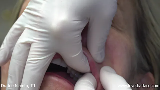 Restylane Cannula Injection to Nasolabial Folds