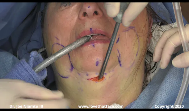 Submental Placement of Silicone Chin Implant Case 2