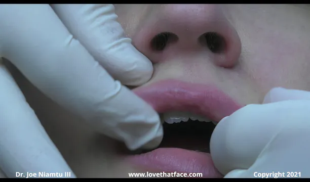Cannula Injection to Upper Lip with Restylane