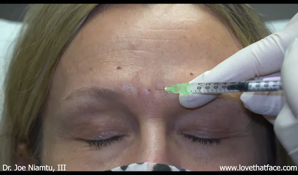 Botox to Glabella and Frontalis 1C
