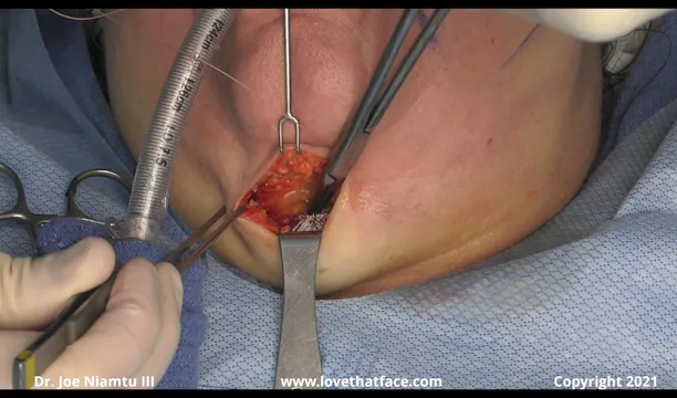 Close Up Great Platysmaplasty Case 1