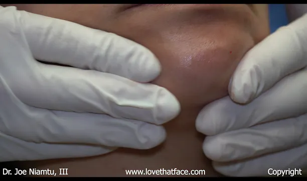 Fiiller Injection to Chin