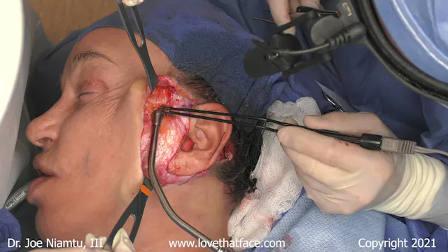 Case 3 Revision Facelift Part 2