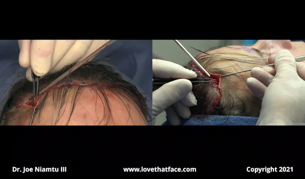 Transfollicular Brow and Forehead Lift with Upper Blepharoplasty  Case 3