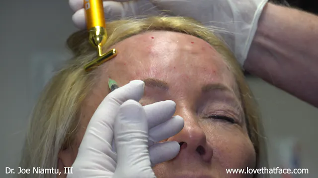 Botox to Glabella, Frontalis, Lateral Canthus, Bunny Lines, Mentalis and DAO