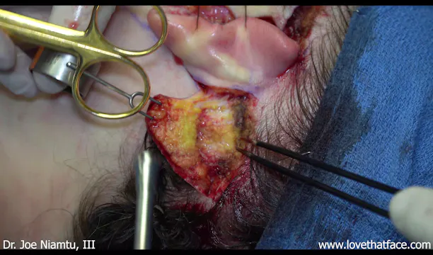 Facelift Incision and Flap Development