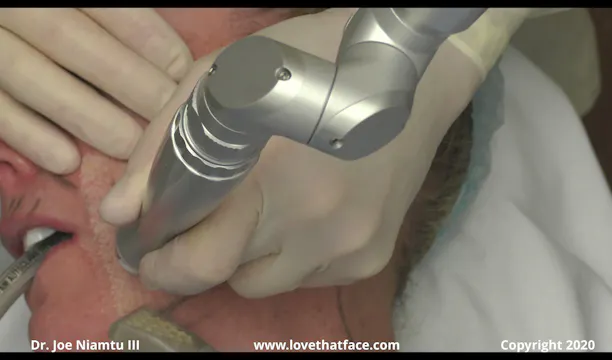 Case 5 Full Face CO2 Laser to Face and Neck