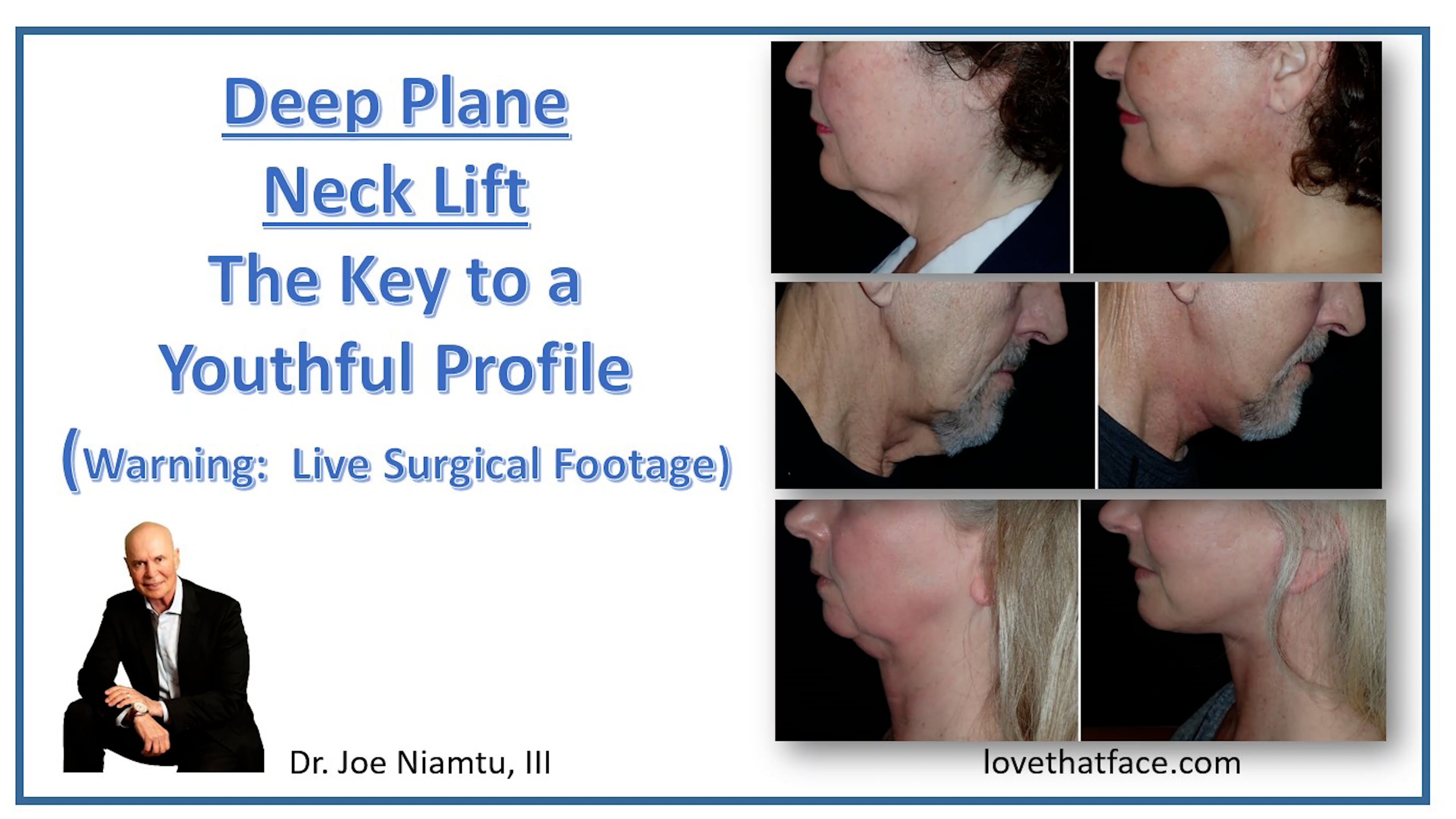 Deep Neck Lift Explained 2