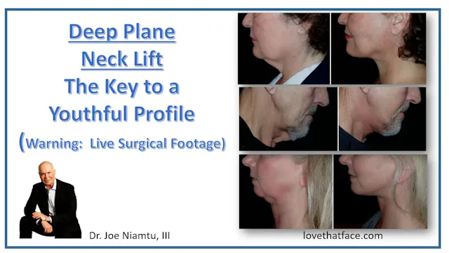Deep Neck Lift Explained 2
