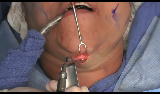 Case 3 Revision Facelift Part 1