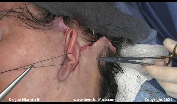 Key Sutures and Skin Flap Trimming