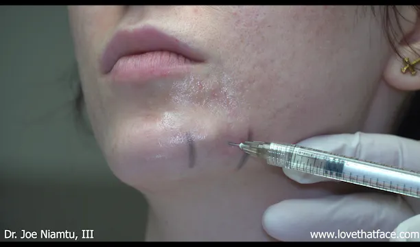 Filler to Mandibular Border