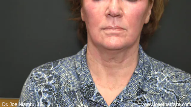 1week post CO2 Full Face Laser Resurfacing