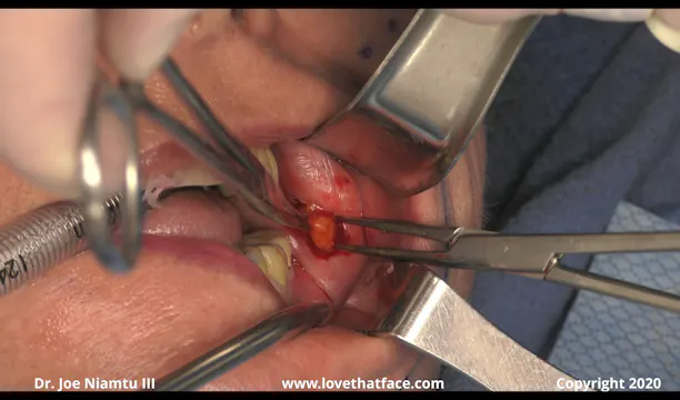Buccal Fat Reduction on Multiple patients Case 3