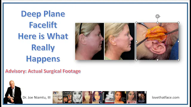 Deep Plane Facelift What Really Happens final