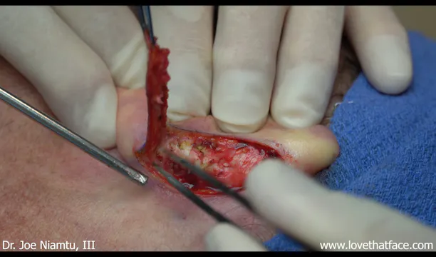 Case 1 Otoplasty with Mustarde Sutures and Mini Davis Cartilage Procedure