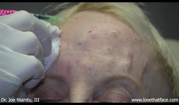 Botox to Glabella and Frontalis 1A