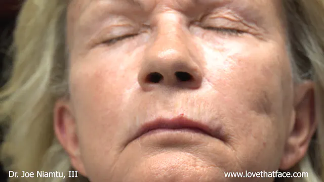 Volbella to Lip Lines, Outline and Plumping