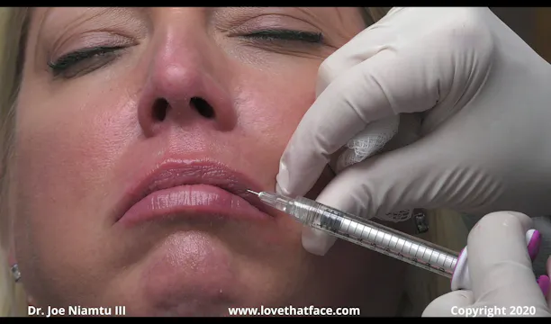 Single Syringe of Juvederm Volbella to Lips