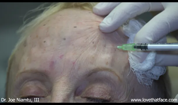 Botox to Glabella and Frontalis 1A