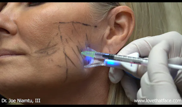 Botox to Masseter Muscle