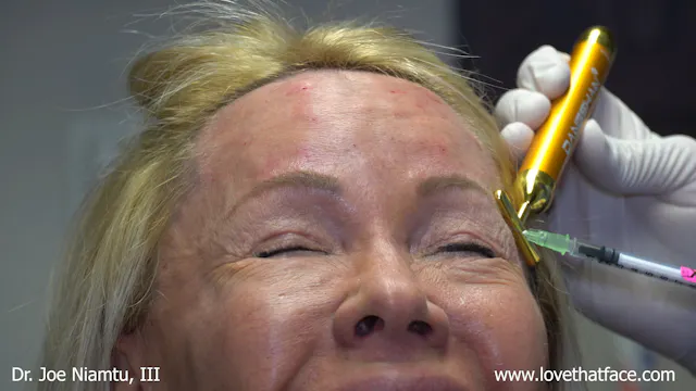 Botox to glabella, frontalis, lateral canthus, bunny lines, mentalis and DAO