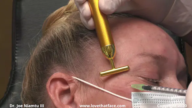 Botox to Frontalis, Glabella, Lateral Canthus