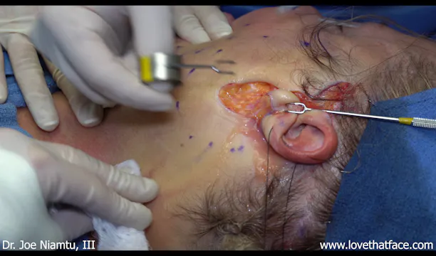 Weekend Short Scar Facelift Case 1